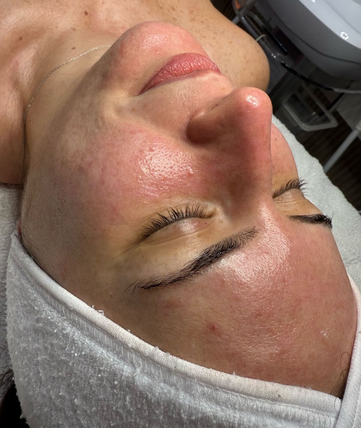 אחרי Glow Facial