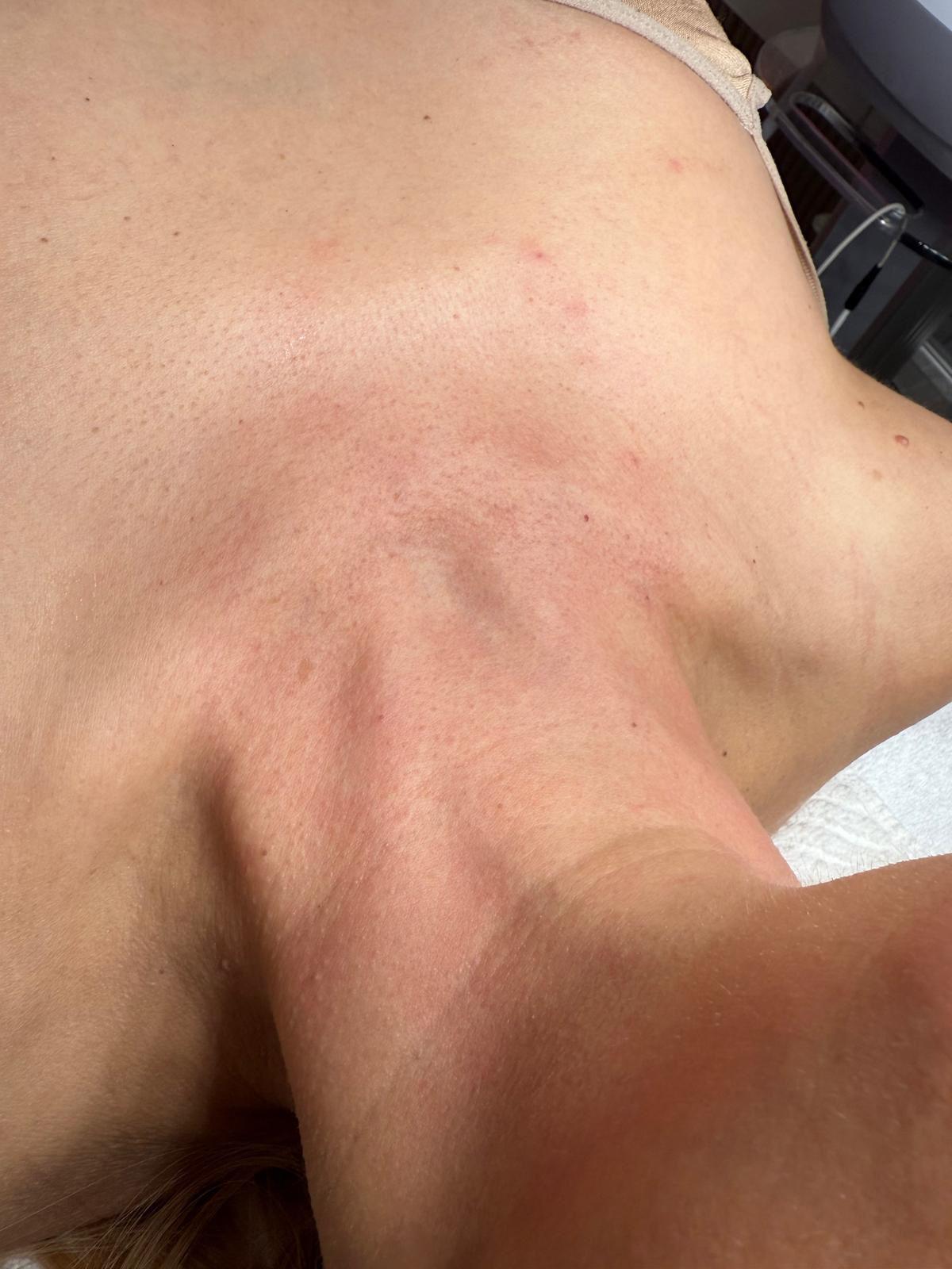 אחרי Hydra Facial