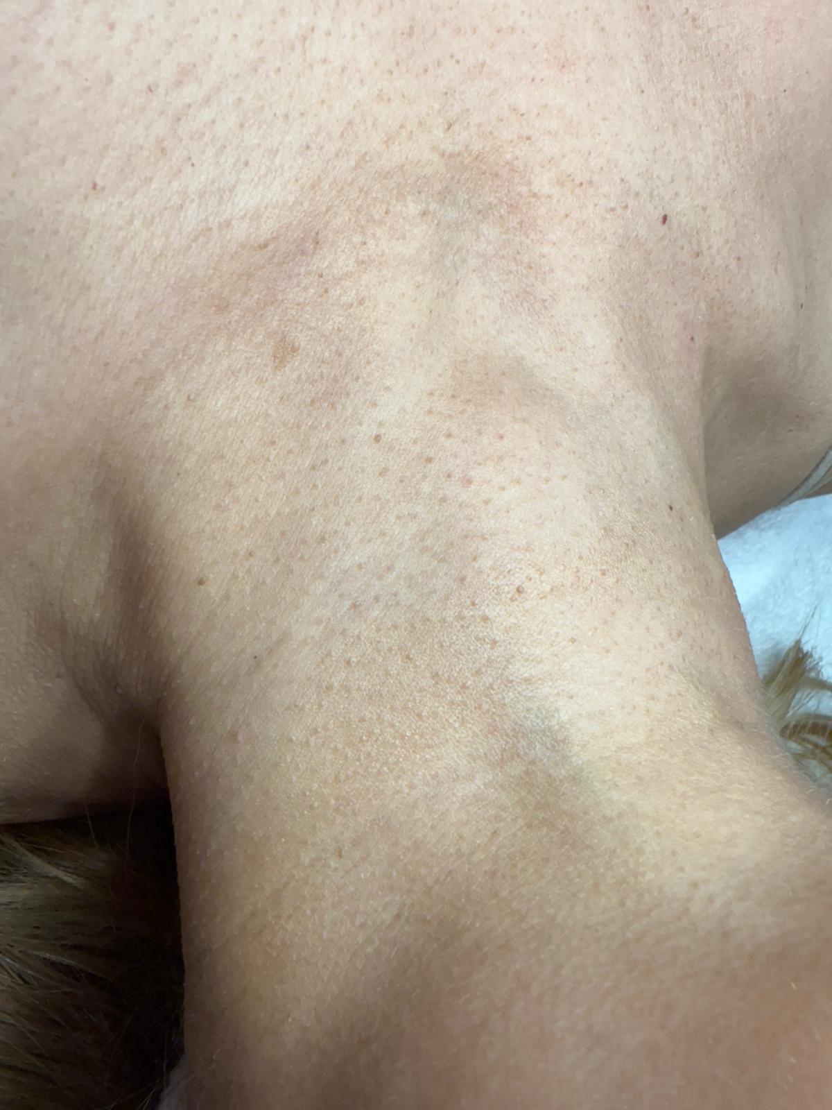 לפני Hydra Facial