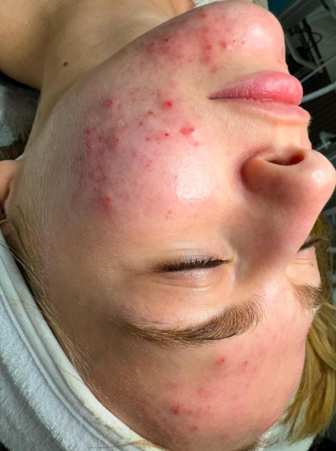 לפני טיפול אקנה