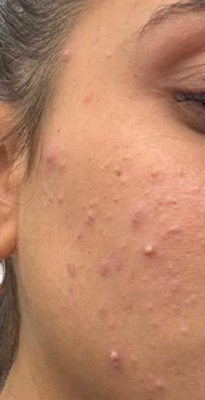 טיפול באקנה