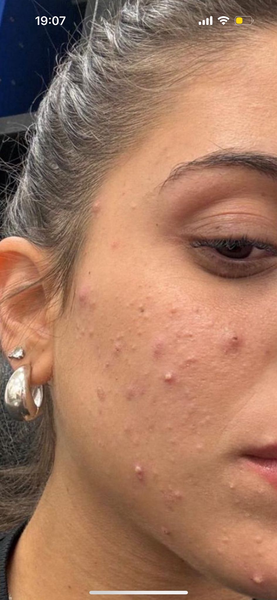 לפני טיפול אקנה