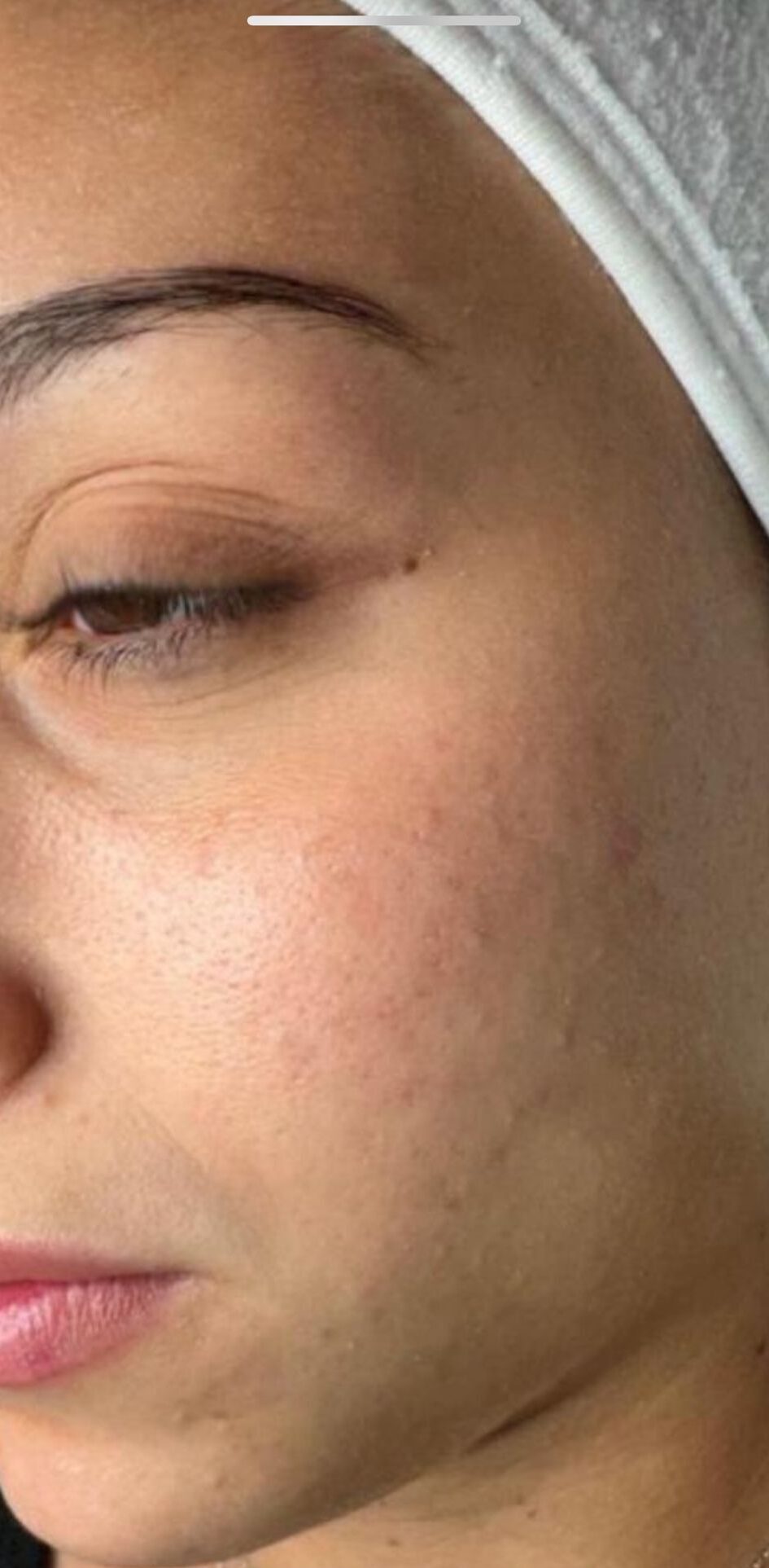 אחרי טיפול אקנה