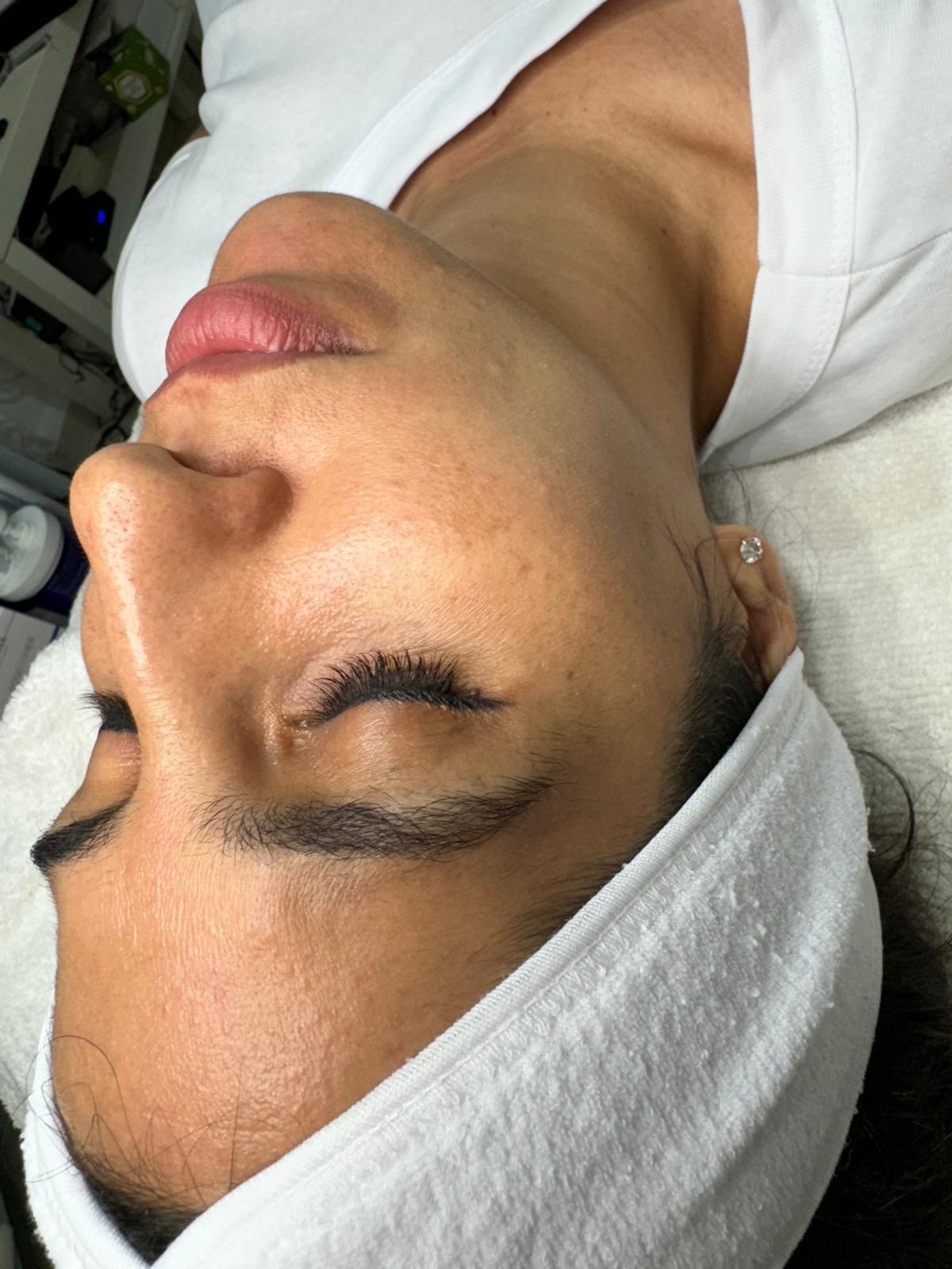 לפני טיפול זוהר