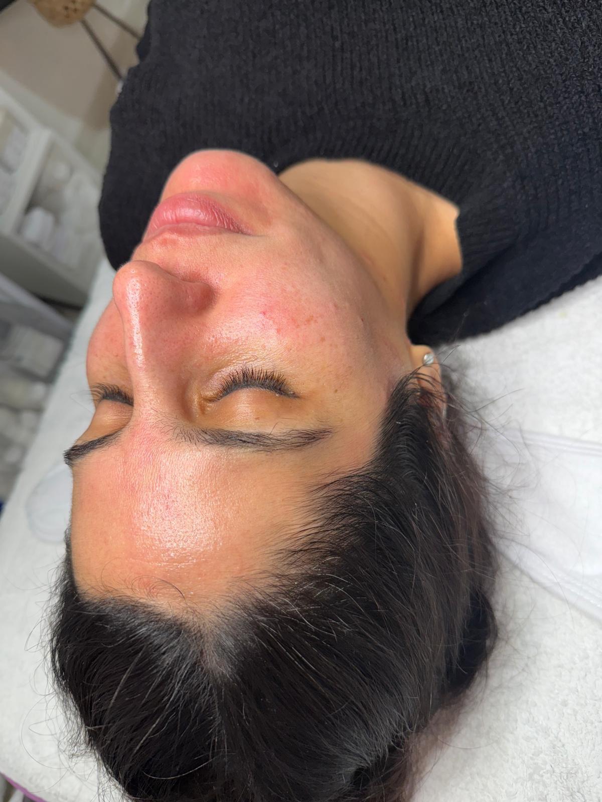 אחרי טיפול זוהר